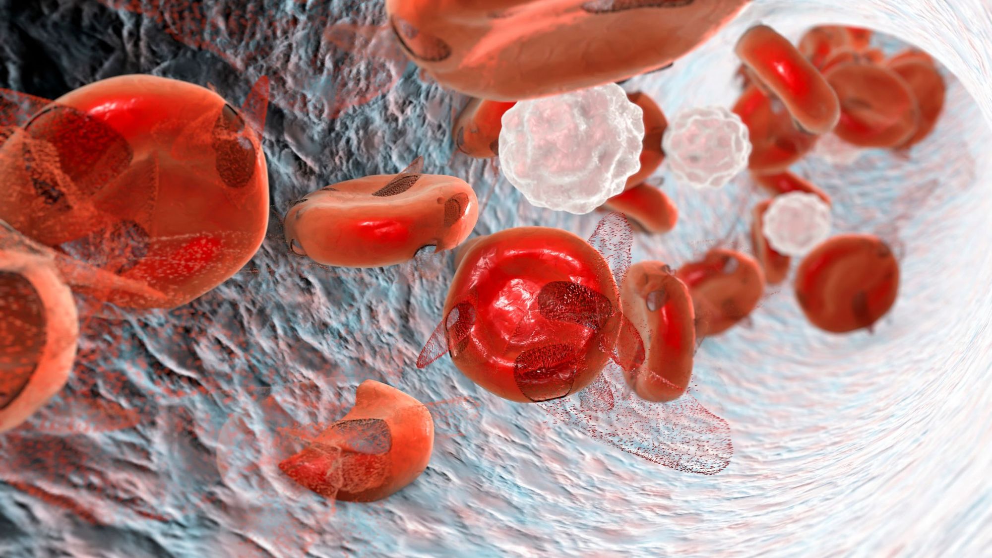 St. Jude Research on X: People with sickle cell disease have red blood  cells that contain mostly hemoglobin S, which causes the red blood cells to  change from a round circle shape