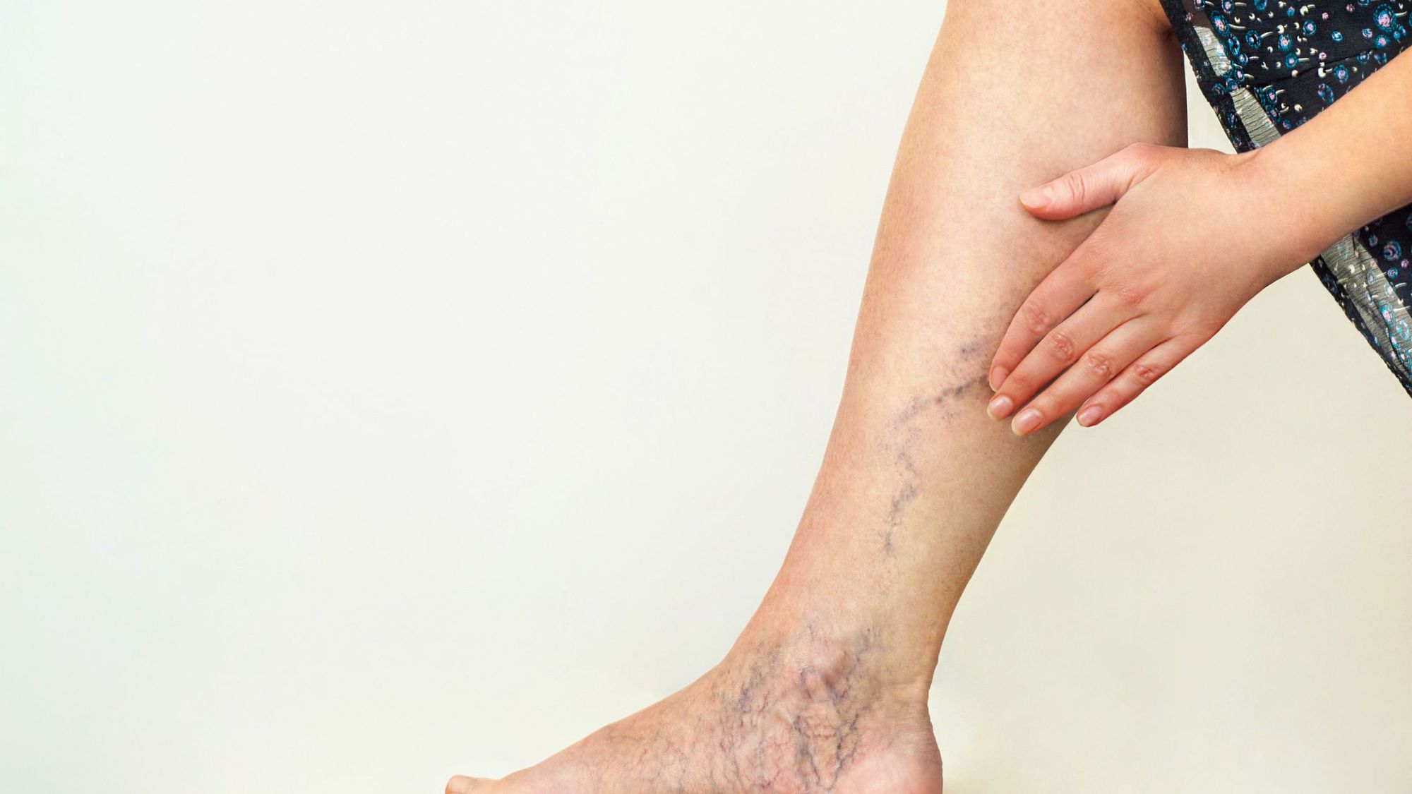 Varicose Veins: Causes, Prevention, and Treatment