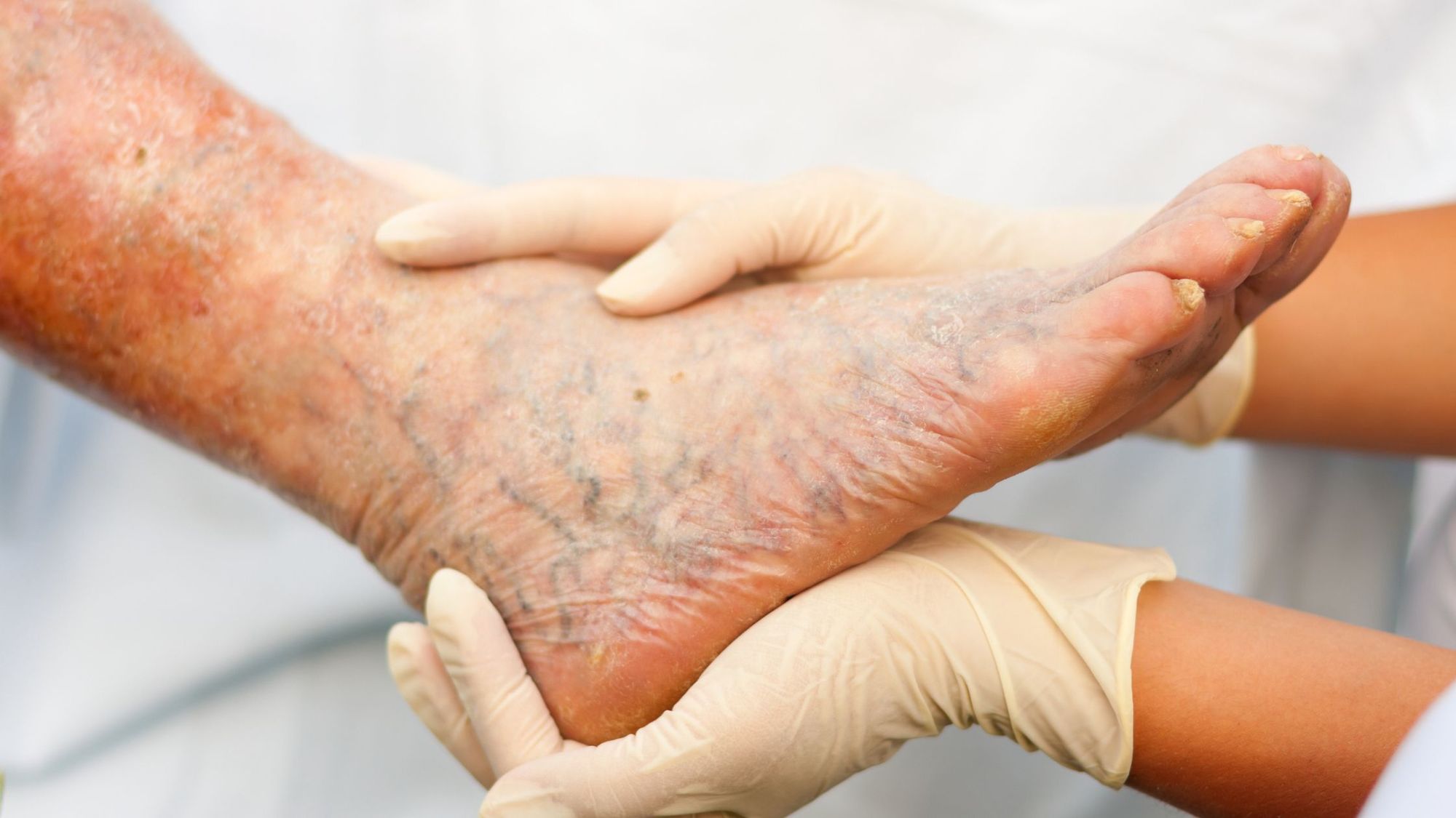 Varicose Veins: Causes, Prevention, and Treatment